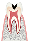 C3：虫歯が神経に達する