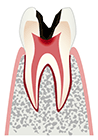 C4：歯根に虫歯が達する
